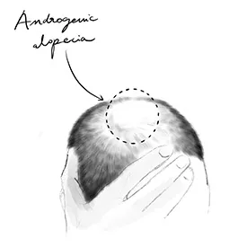 Alopécie androgénique masculine