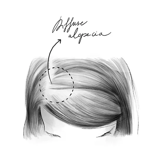 Alopécie diffuse